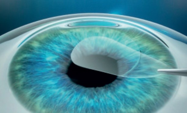 Step 2: Removal of lenticule